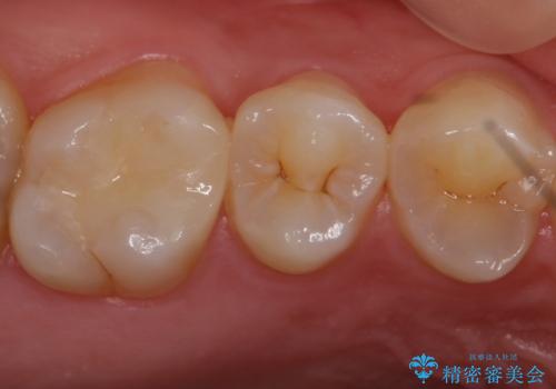 歯と歯の間の虫歯 セラミックインレーでの治療の治療後