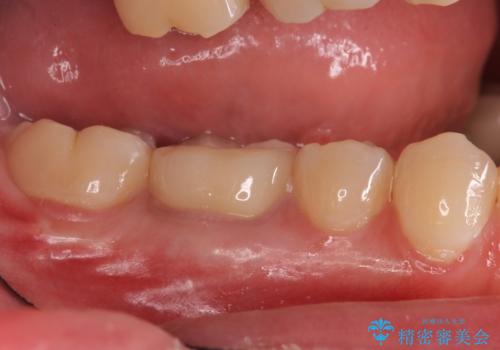 樹脂をセラミックにしたい ジルコニアクラウンでの治療の治療後