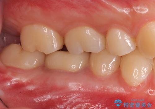 樹脂をセラミックにしたい ジルコニアクラウンでの治療の治療後
