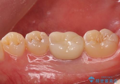 樹脂をセラミックにしたい ジルコニアクラウンでの治療の治療後