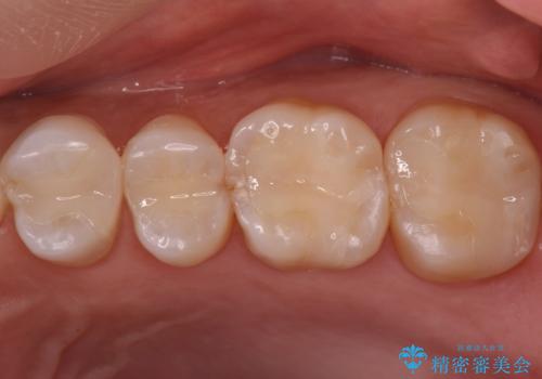 銀歯と樹脂の詰め物のやり替え　セラミックインレーでの治療の治療後
