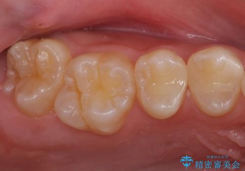 歯と歯の間の虫歯　セラミックインレーでの治療の治療後