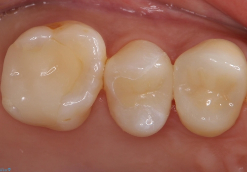 銀歯を白くしたいの症例 治療後