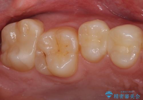 歯と歯の間の虫歯 セラミックインレーでの治療の治療後