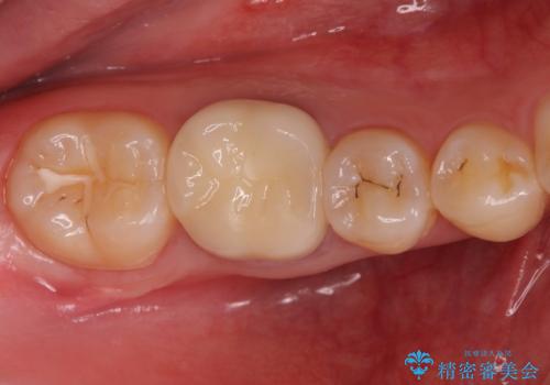 樹脂をセラミックにしたい ジルコニアクラウンでの治療の症例 治療後