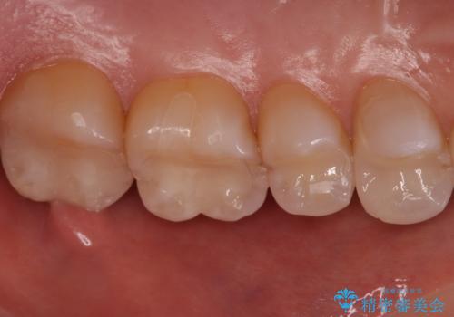 銀歯と樹脂の詰め物のやり替え　セラミックインレーでの治療の治療後