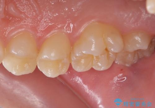 歯と歯の間の虫歯 セラミックインレーでの治療の治療後