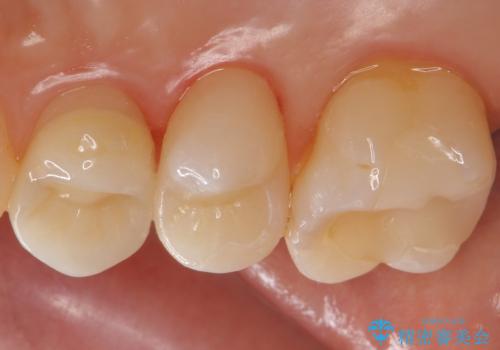 銀歯を白くしたいの治療後