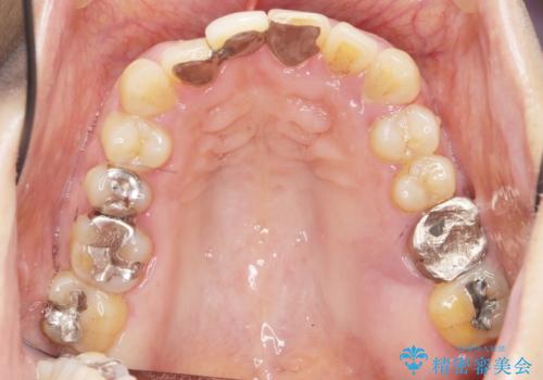 歯周病に対する全体治療の治療前