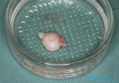 マウスピース矯正前に行う骨隆起の除去の治療中