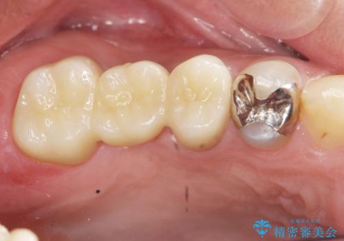 「 セラミック治療 」奥歯を白くしたいの治療後