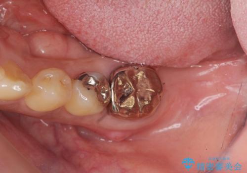 歯周病に対する全体治療の治療前