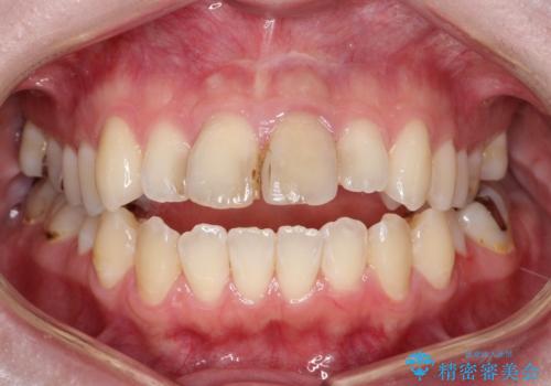 前歯の色が気になる【オールセラミッククラウン】の治療前