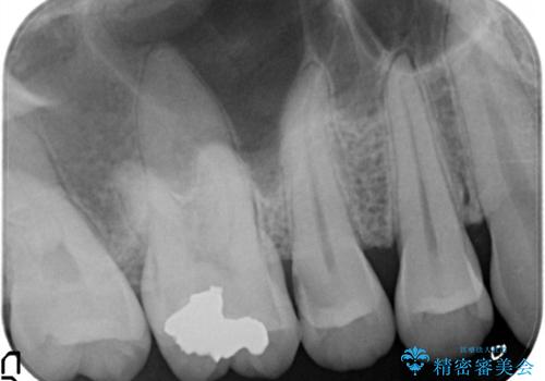 【セラミックインレー】定期検診にて虫歯を発見の治療前