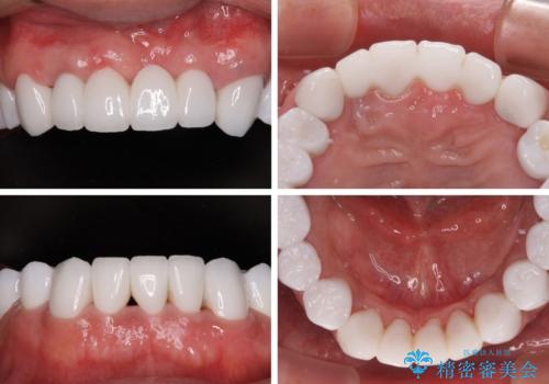 欠損と虫歯だらけの口の中 真っ白なセラミック治療の治療後