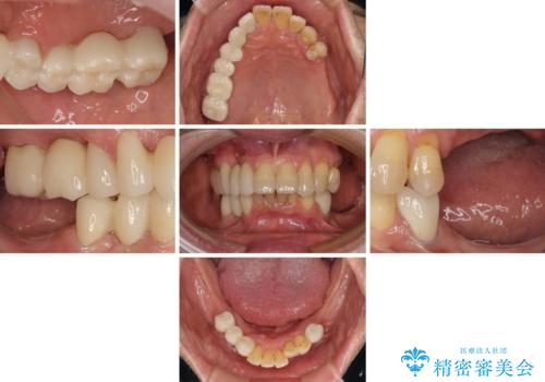 装着感の良い入れ歯を作りたい 金属床を使用した適合の良い部分床義歯の治療中
