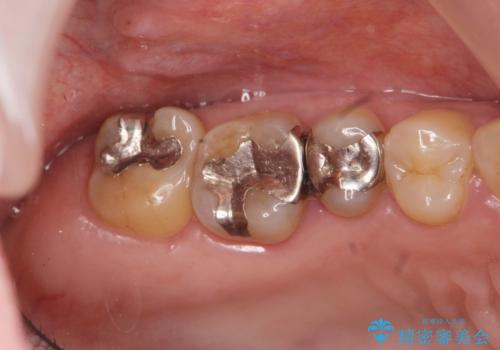 歯周病に対する全体治療の治療前