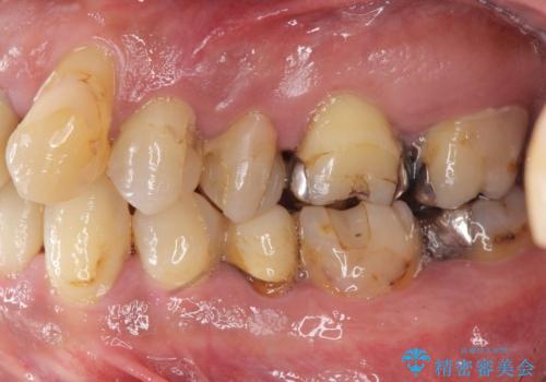 [ 重度歯周病 ] 骨造成・インプラント治療による咬合機能の回復の症例 治療前
