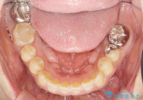 歯周病に対する全体治療の治療前