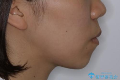 インビザライン単独での抜歯矯正治療の治療前(顔貌)