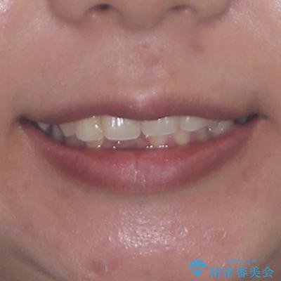 深い咬み合わせと前歯のデコボコ　インビザラインによる矯正治療の治療前（顔貌）
