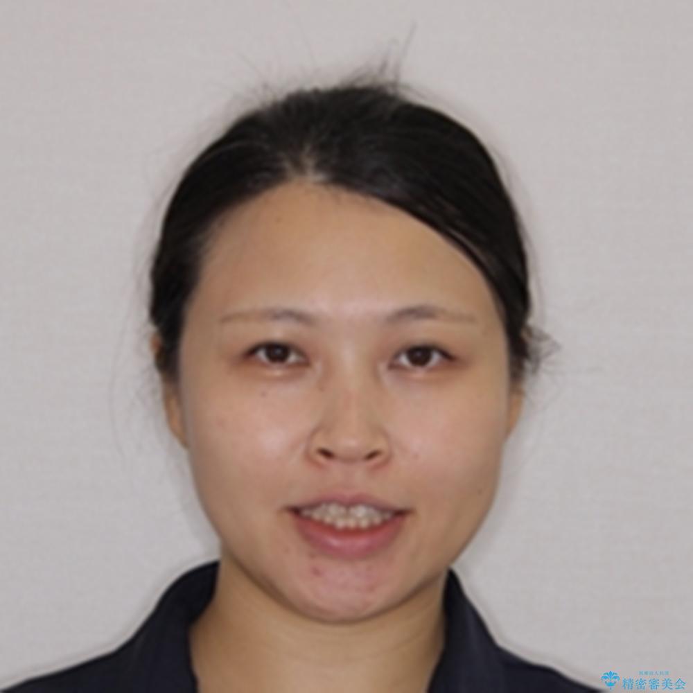 【モニター】前歯のデコボコを治したい インビザラインを用いた矯正治療の治療前(顔貌)