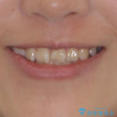 重度叢生と埋もれた奥歯 8本を抜歯したワイヤー矯正の治療前(顔貌)