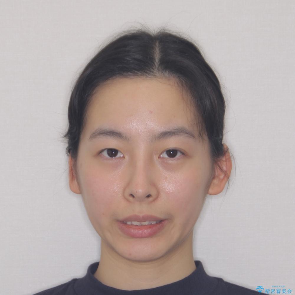 【モニター】隠れている下顎の前歯をインビザラインで改善の治療前(顔貌)