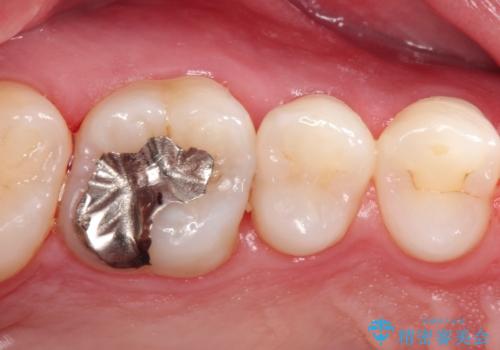 【セラミックインレー】定期検診にて虫歯を発見の治療前