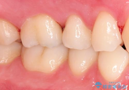 【セラミックインレー】定期検診にて虫歯を発見の治療前