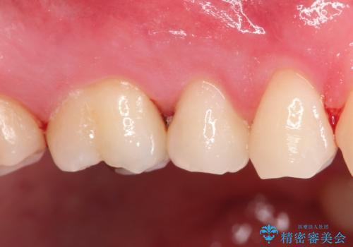 【セラミックインレー】定期検診にて虫歯を発見の治療前