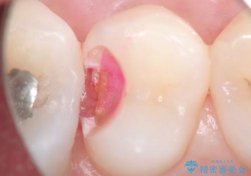 【セラミックインレー】定期検診にて虫歯を発見の治療前
