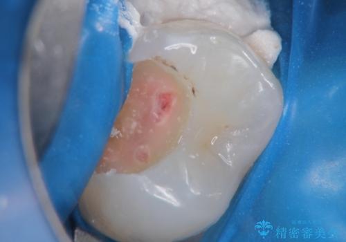 【セラミックインレー】定期検診にて虫歯を発見の治療後