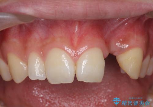 前歯部 インプラント治療の治療前