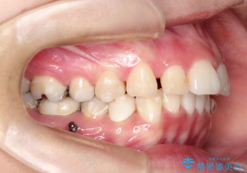 【インビザライン】虫歯の多い方の矯正治療の治療中