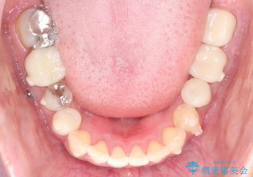 【インビザライン】虫歯の多い方の矯正治療の治療中
