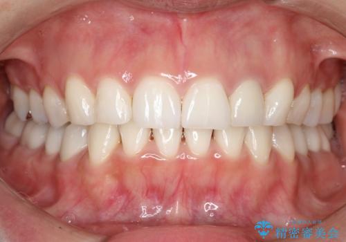 【インビザライン】虫歯の多い方の矯正治療の症例 治療後
