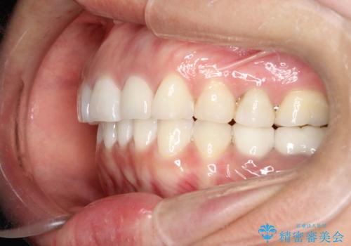【インビザライン】虫歯の多い方の矯正治療の治療後