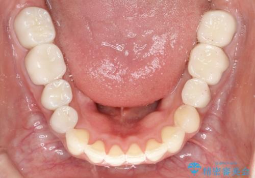 【インビザライン】虫歯の多い方の矯正治療の治療後