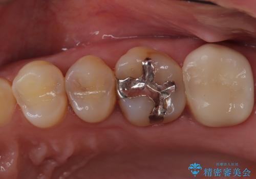 【セラミックインレー】虫歯の治療の治療前