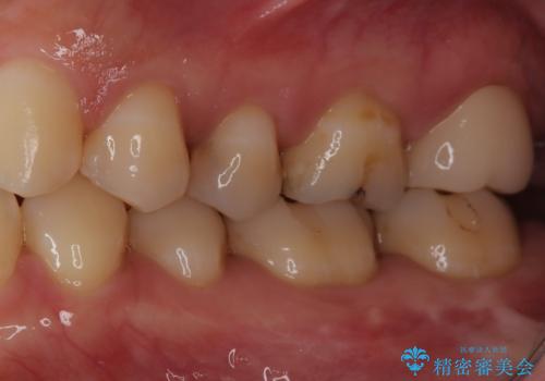 【セラミックインレー】虫歯の治療の治療前