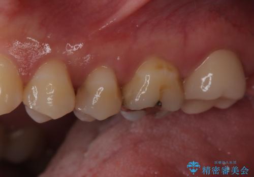 【セラミックインレー】虫歯の治療の治療前