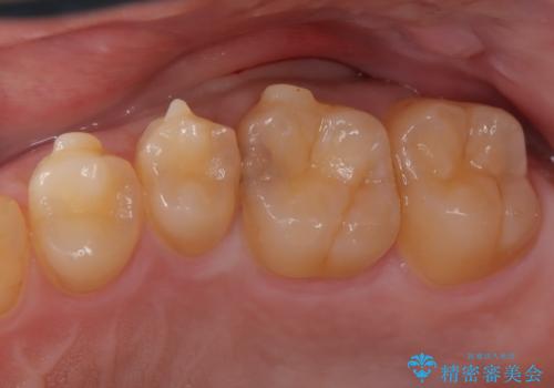 虫歯の再発リスクを減らすセラミックインレーの治療前