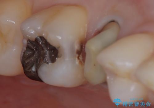 【セラミックインレー】定期検診にて虫歯を発見の治療中