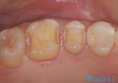 【セラミックインレー】メタルインレーの下が虫歯にの治療中