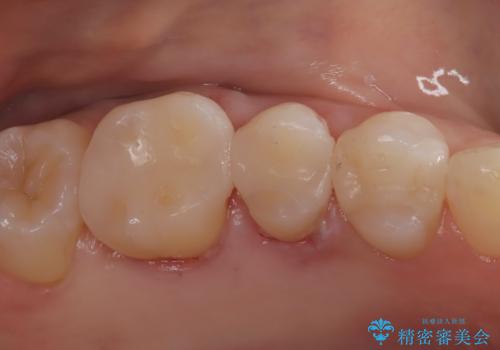 【セラミックインレー】メタルインレーの下が虫歯にの症例 治療後
