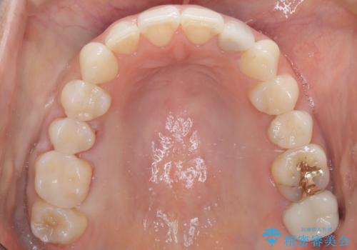 【インビザライン】虫歯の多い方の矯正治療の治療後