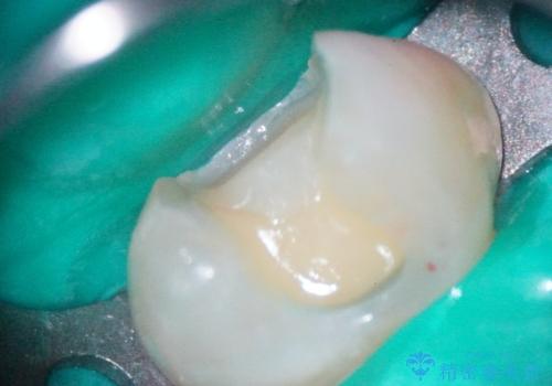 【セラミックインレー】虫歯の治療の治療中