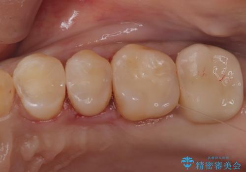【セラミックインレー】虫歯の治療の治療後