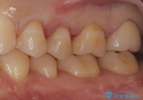 【セラミックインレー】虫歯の治療の治療後
